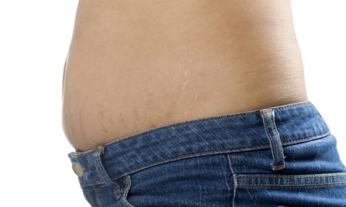 Stretch Mark